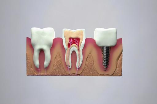 隣接歯への影響を表した画