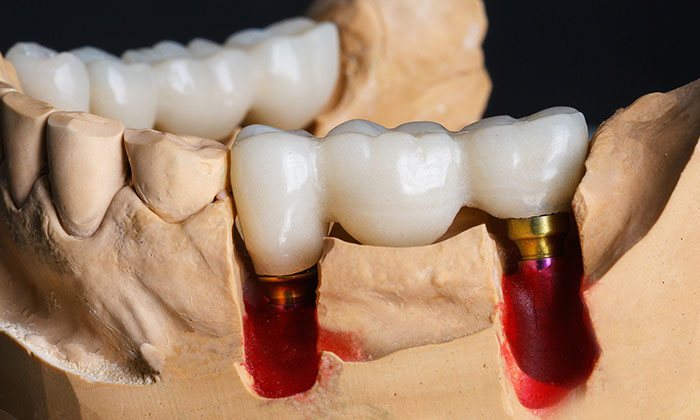 人工歯を作製するための型取り